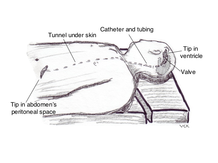 Hydrocephalus Shunt Surgery Hydrocephalus Surgery C N S Neurosurgery