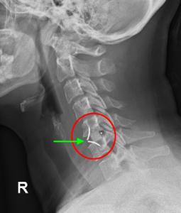 Growing a bridge of bone in the core of cervical fusion cages using