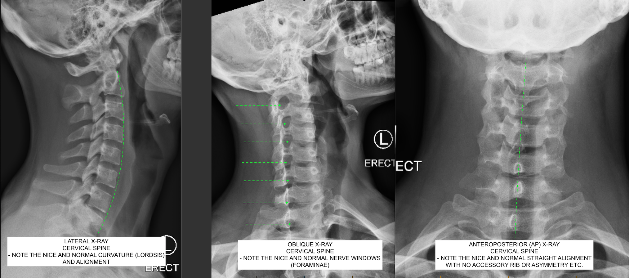 normal hip spine xrays
