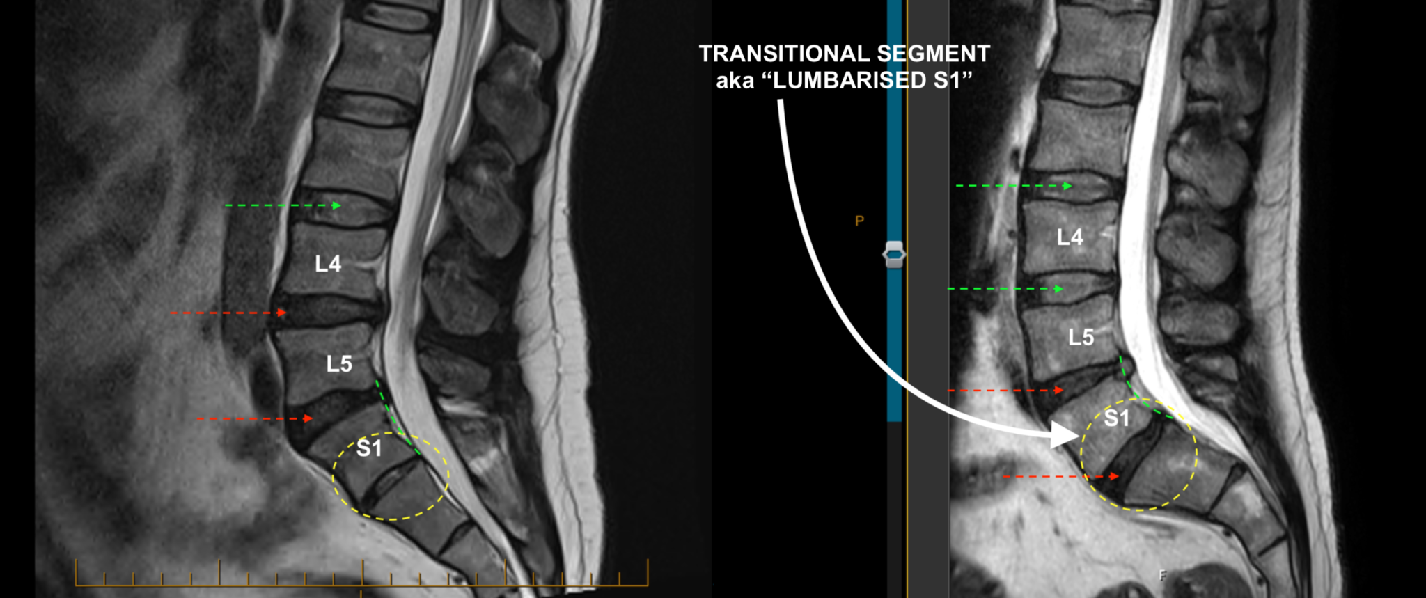 “Lumbarised S1” – The transitional (potentially mobile) lumbosacral ...