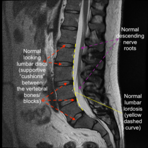 Normal Versus Abnormal Lumbar Anatomy | C.N.S. Neurosurgery