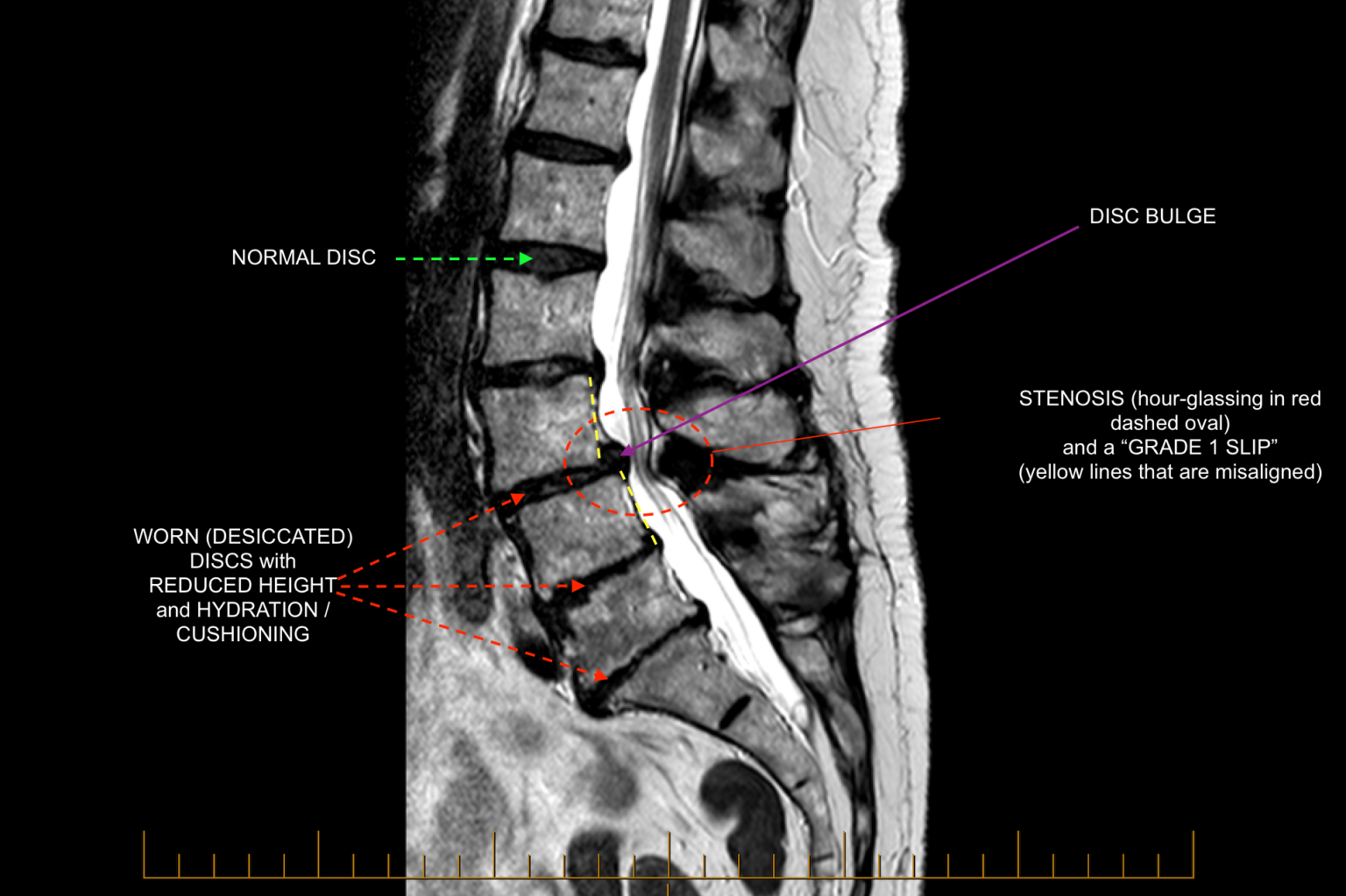 What is an abnormal lumbar MRI?