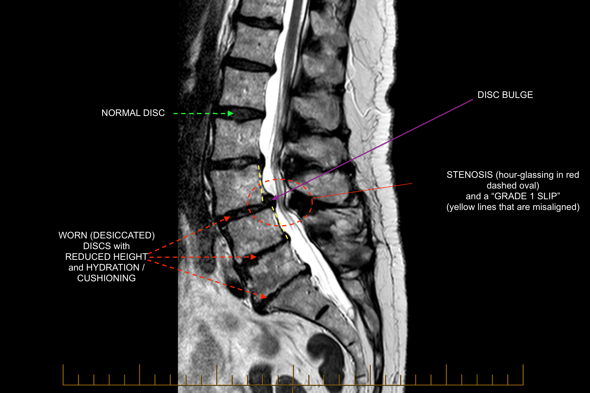 Normal Versus Abnormal Lumbar Anatomy | C.N.S. Neurosurgery