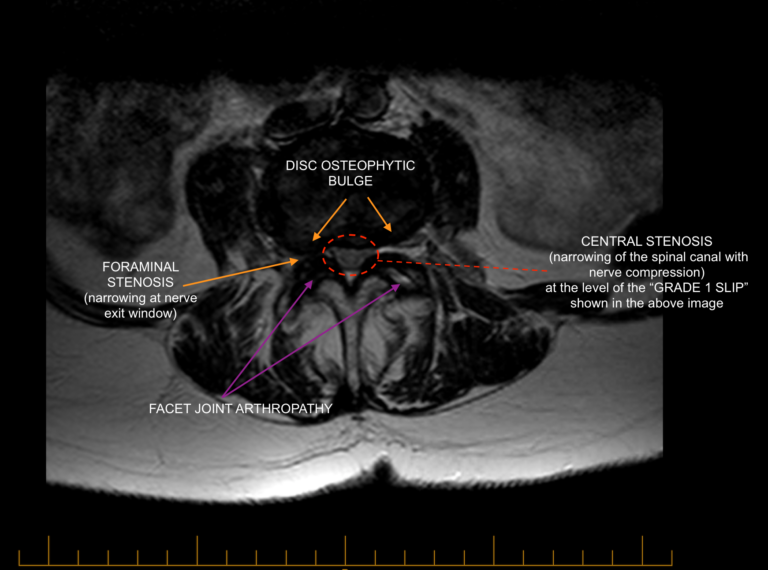 Normal versus abnormal lumbar anatomy | C.N.S. Neurosurgery