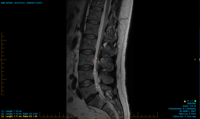 Congenital narrowing of the lumbar spinal canal – Implications | C.N.S ...