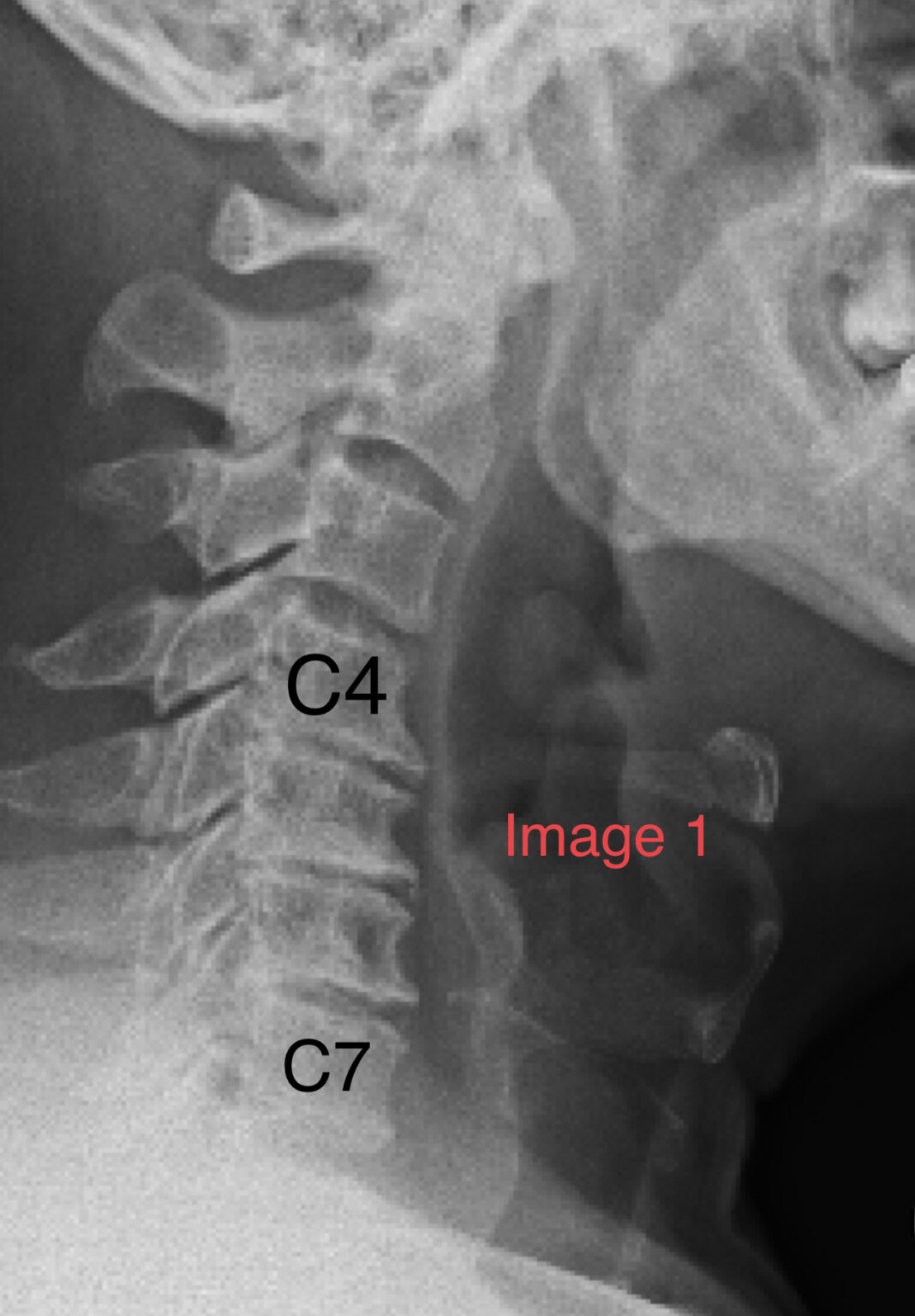 A ‘thing of beauty’ – State-of-the-art anterior hybrid cervical ...